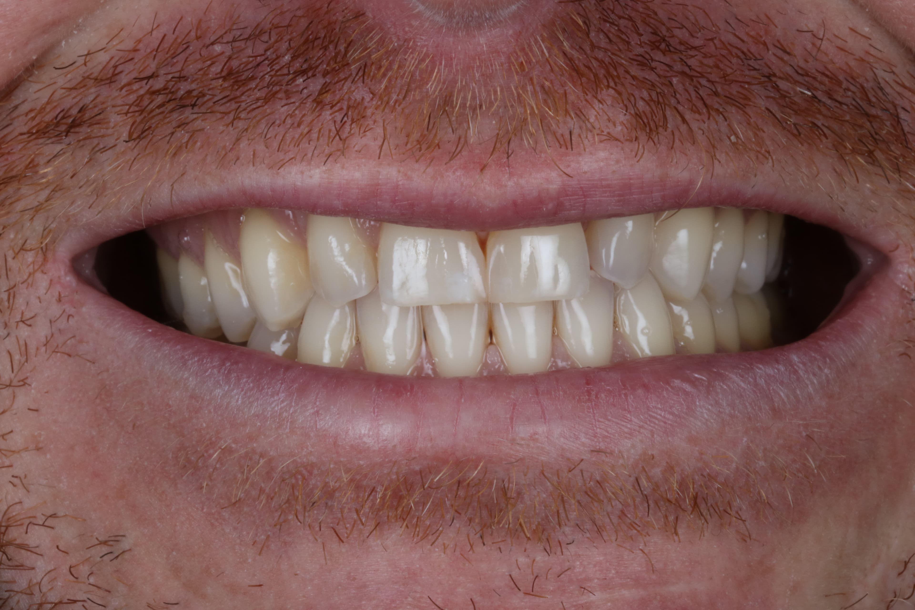 Before Composite Bonding — 10 Teeth
