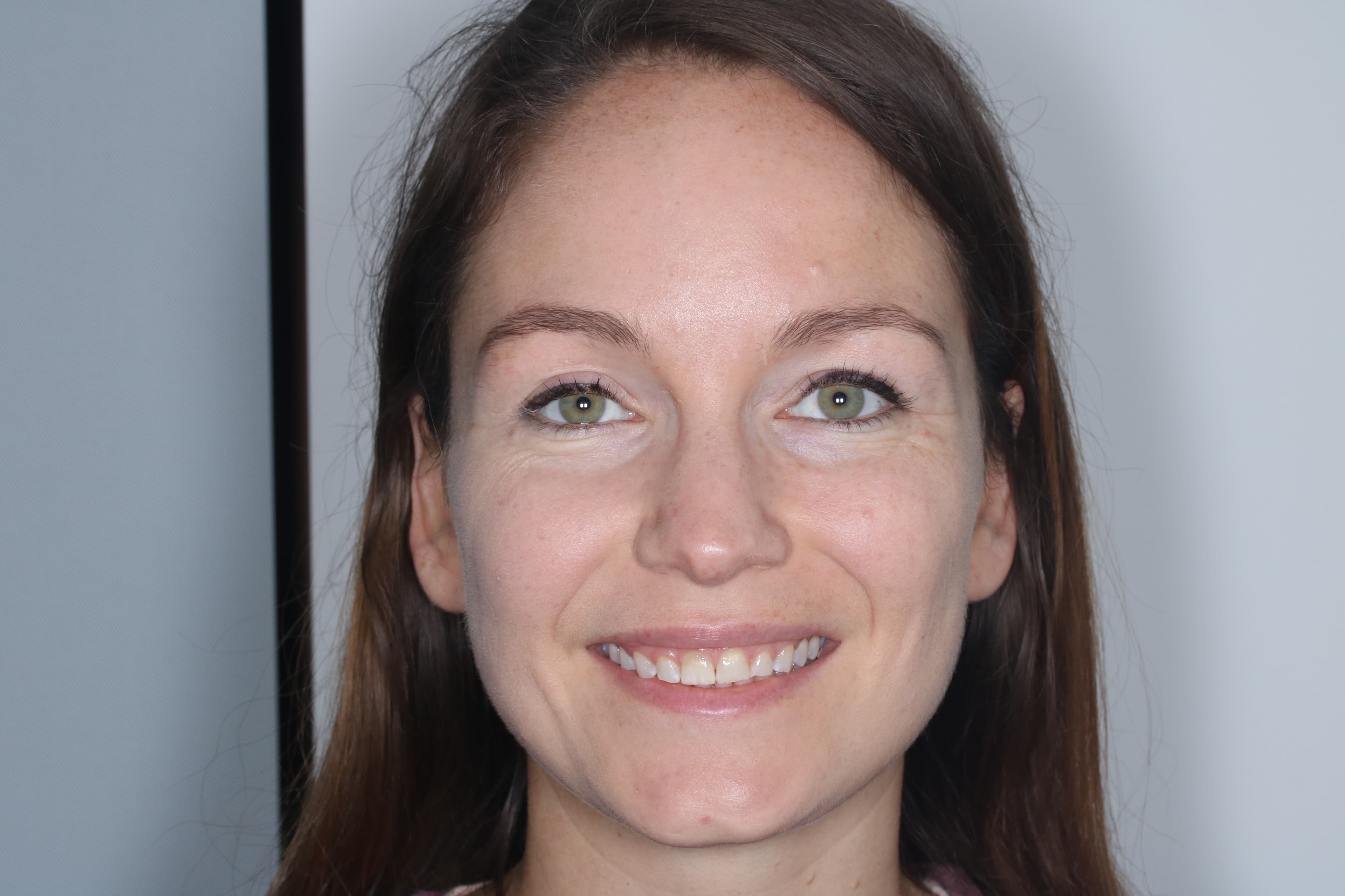 Before Composite Bonding — 6 Teeth