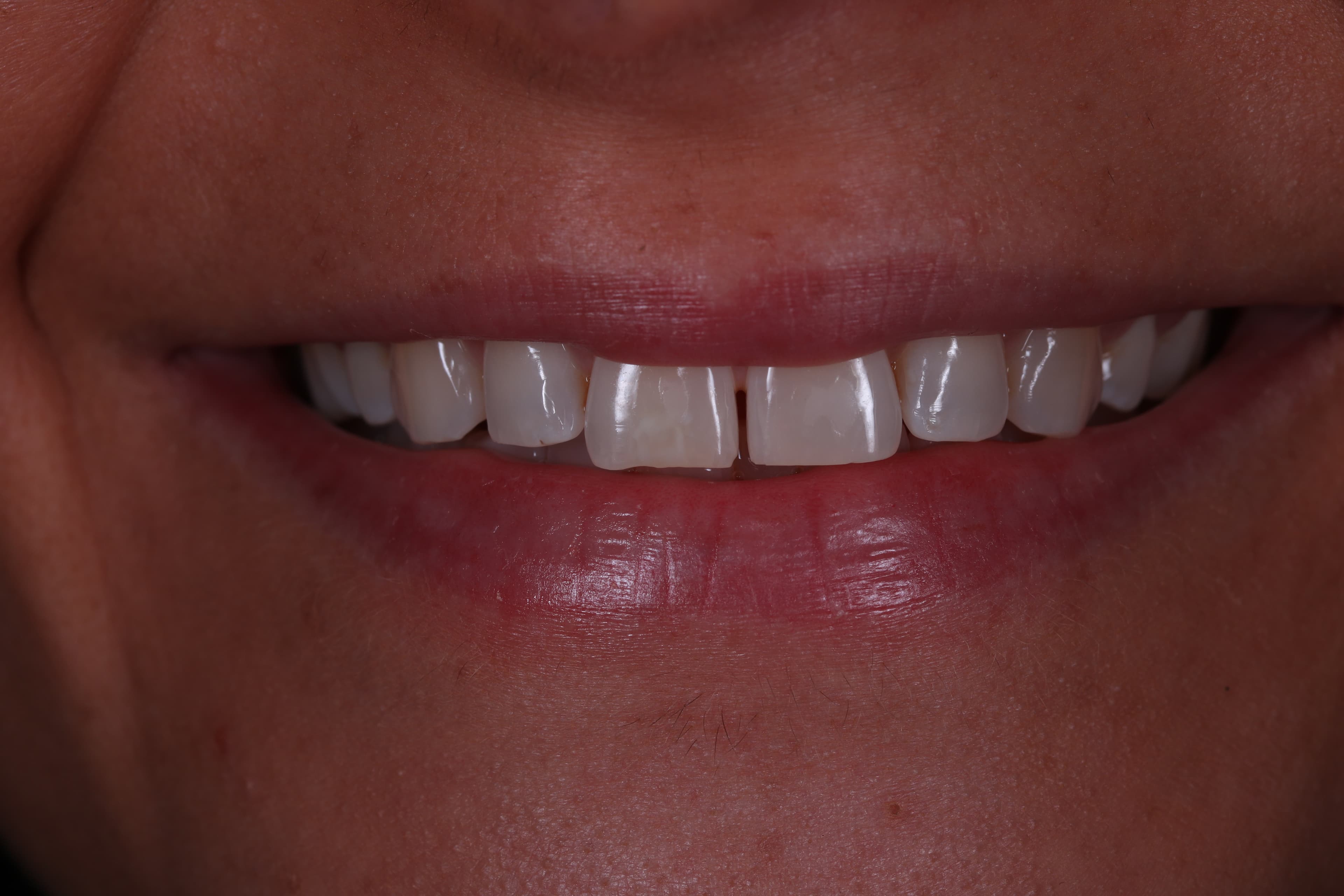 Before Composite Bonding — 10 Teeth