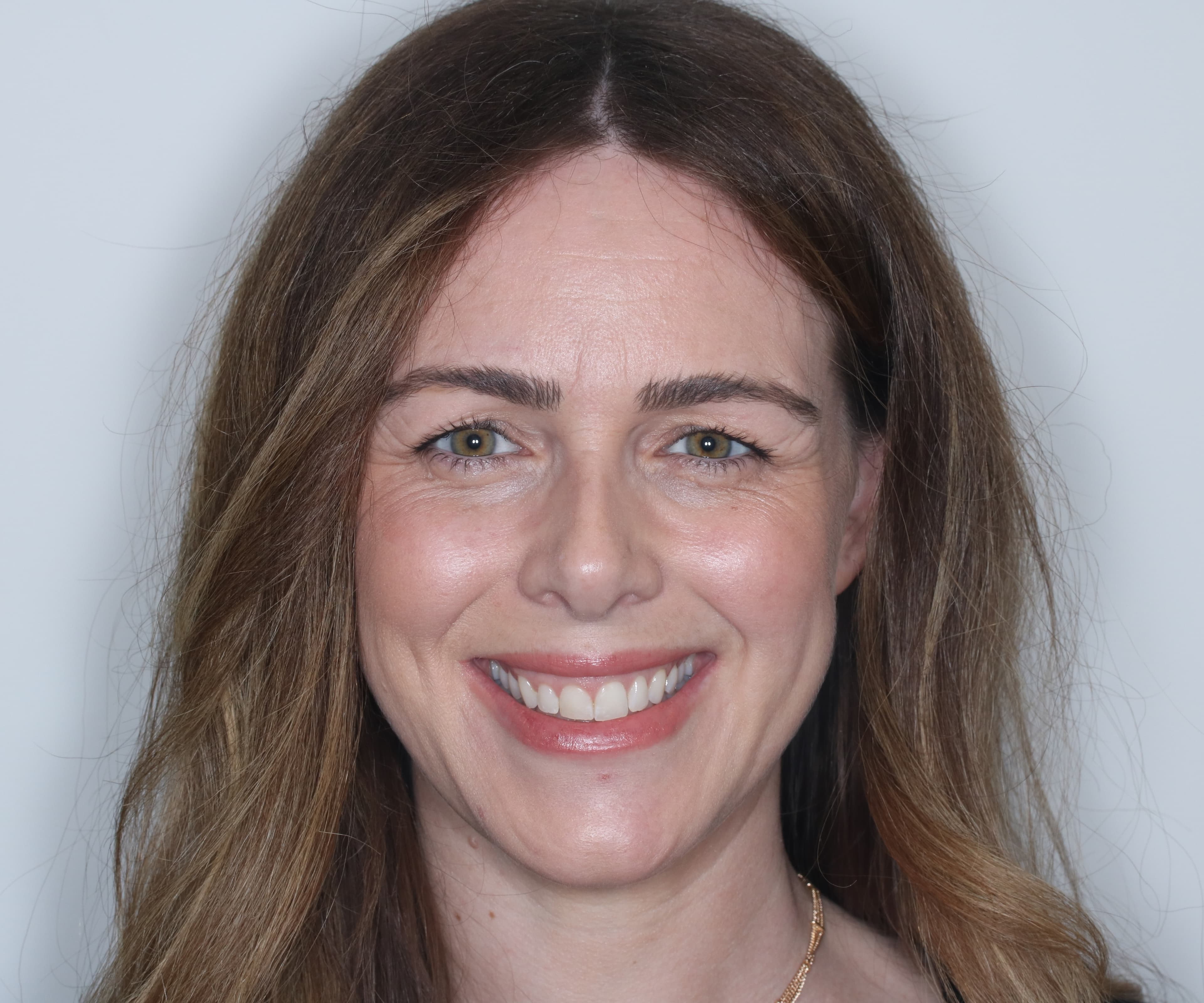 Before Composite Bonding — 8 Teeth