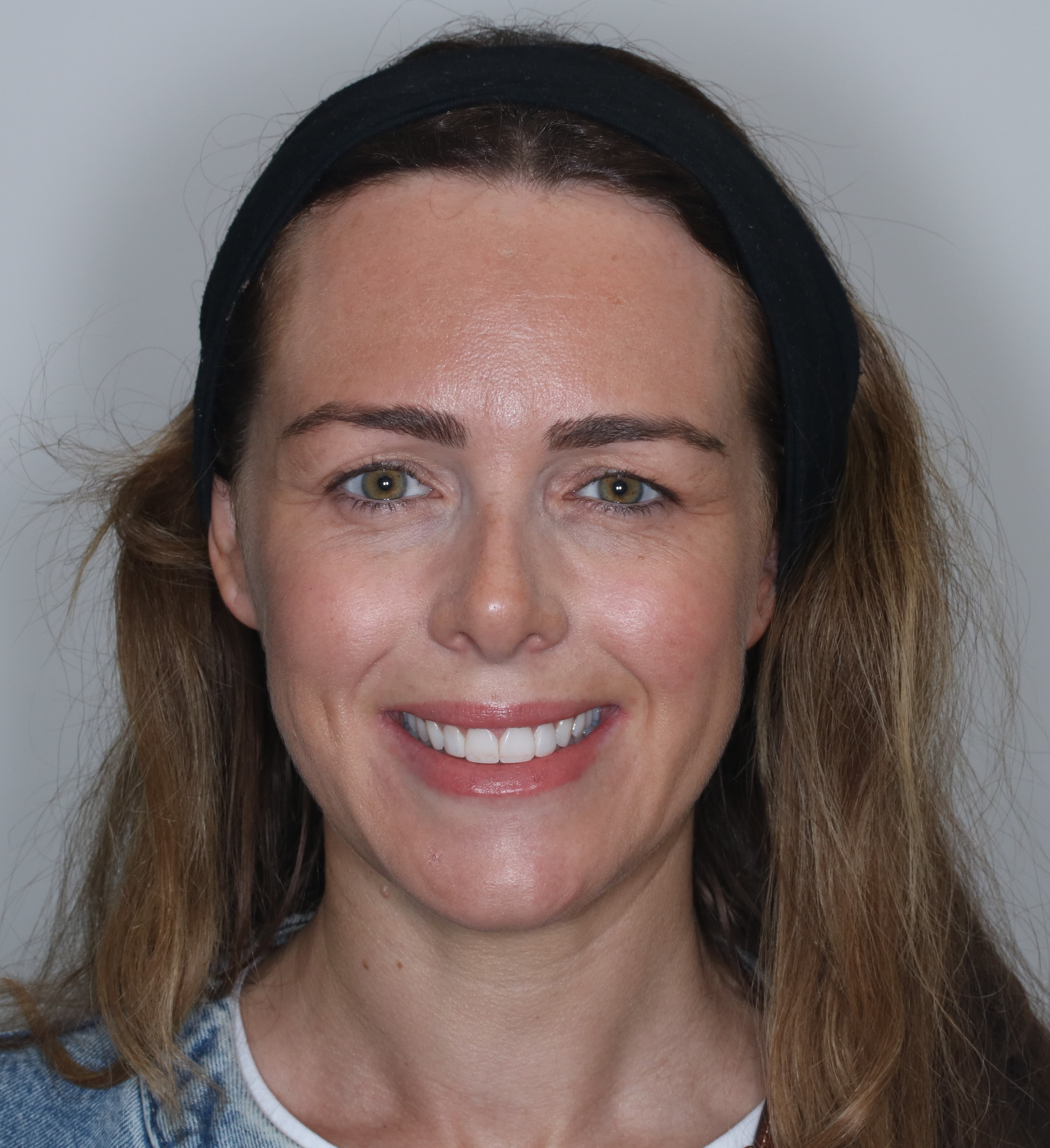 Example smile transformation by Dr Ali Abbasbhai