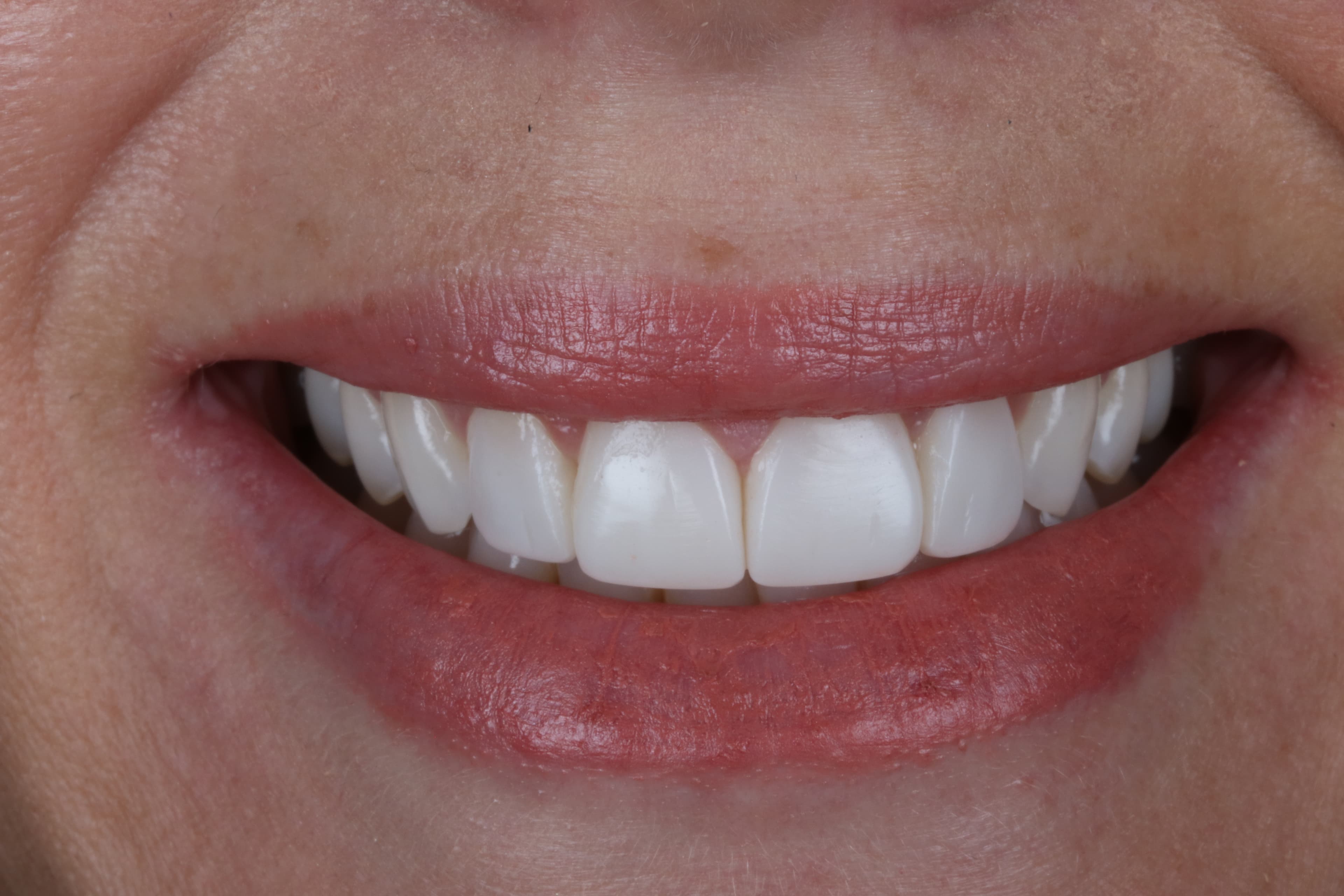 After Composite Bonding — 8 Teeth