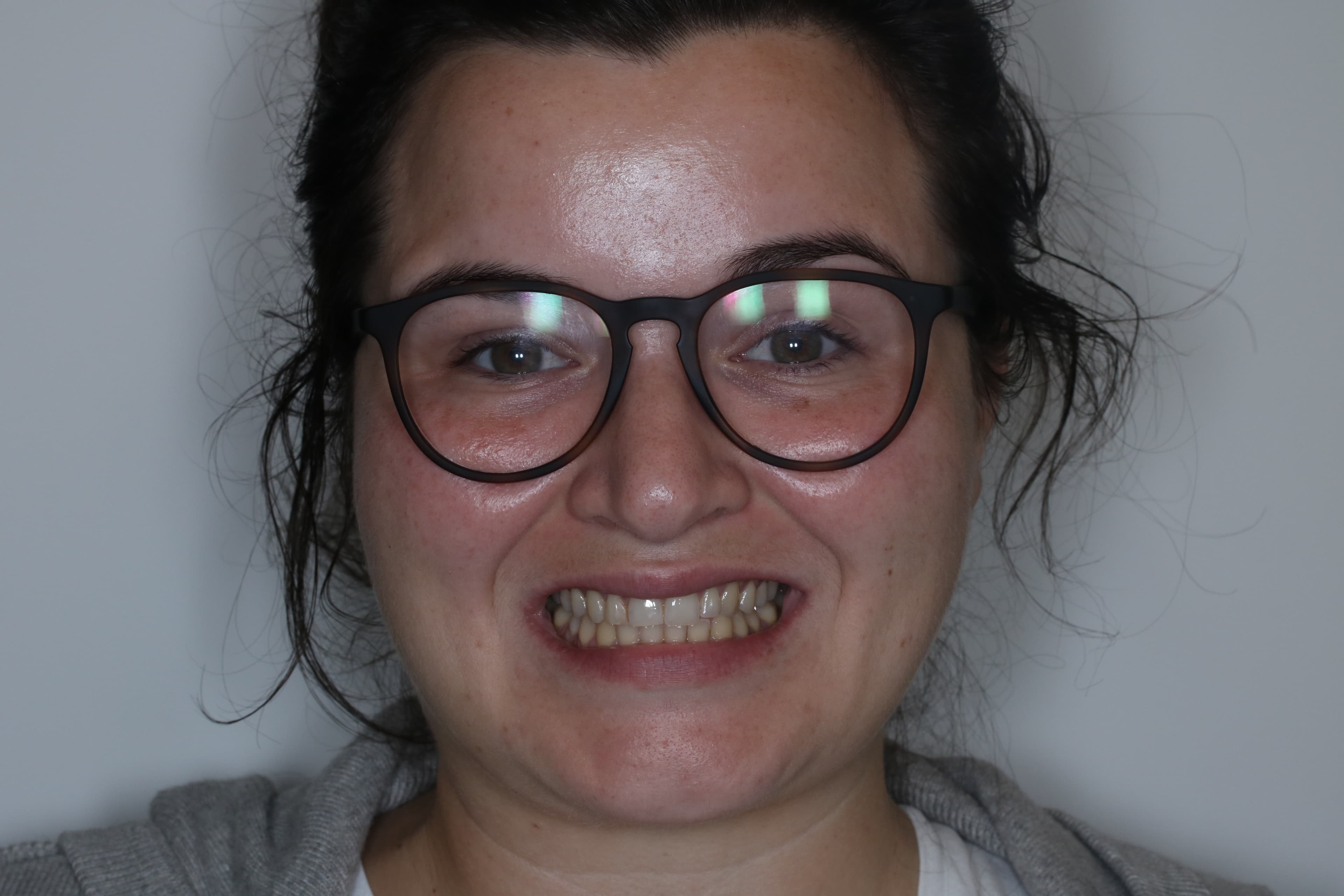 Before Composite Bonding — 10 Teeth