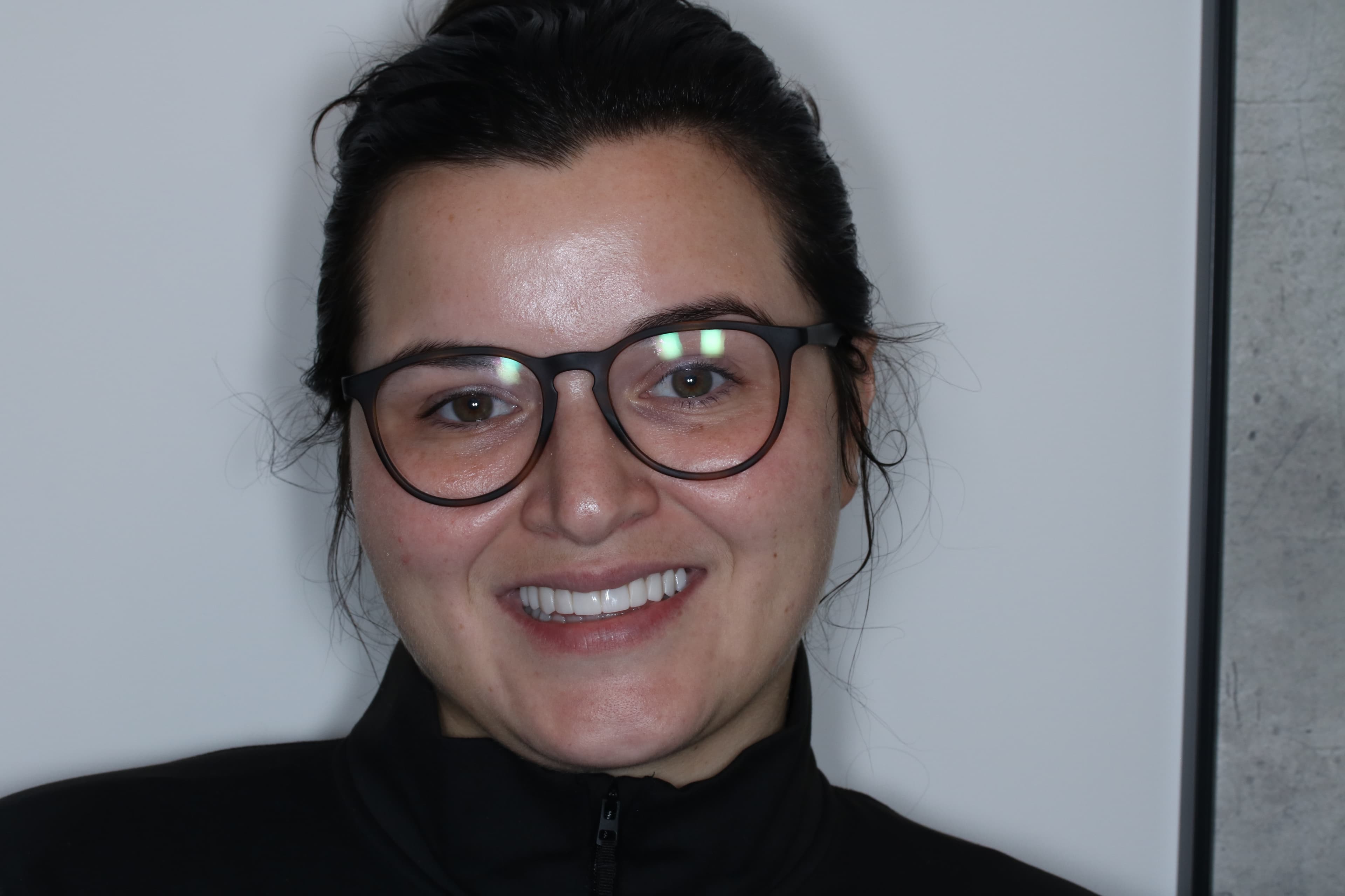 After Composite Bonding — 10 Teeth