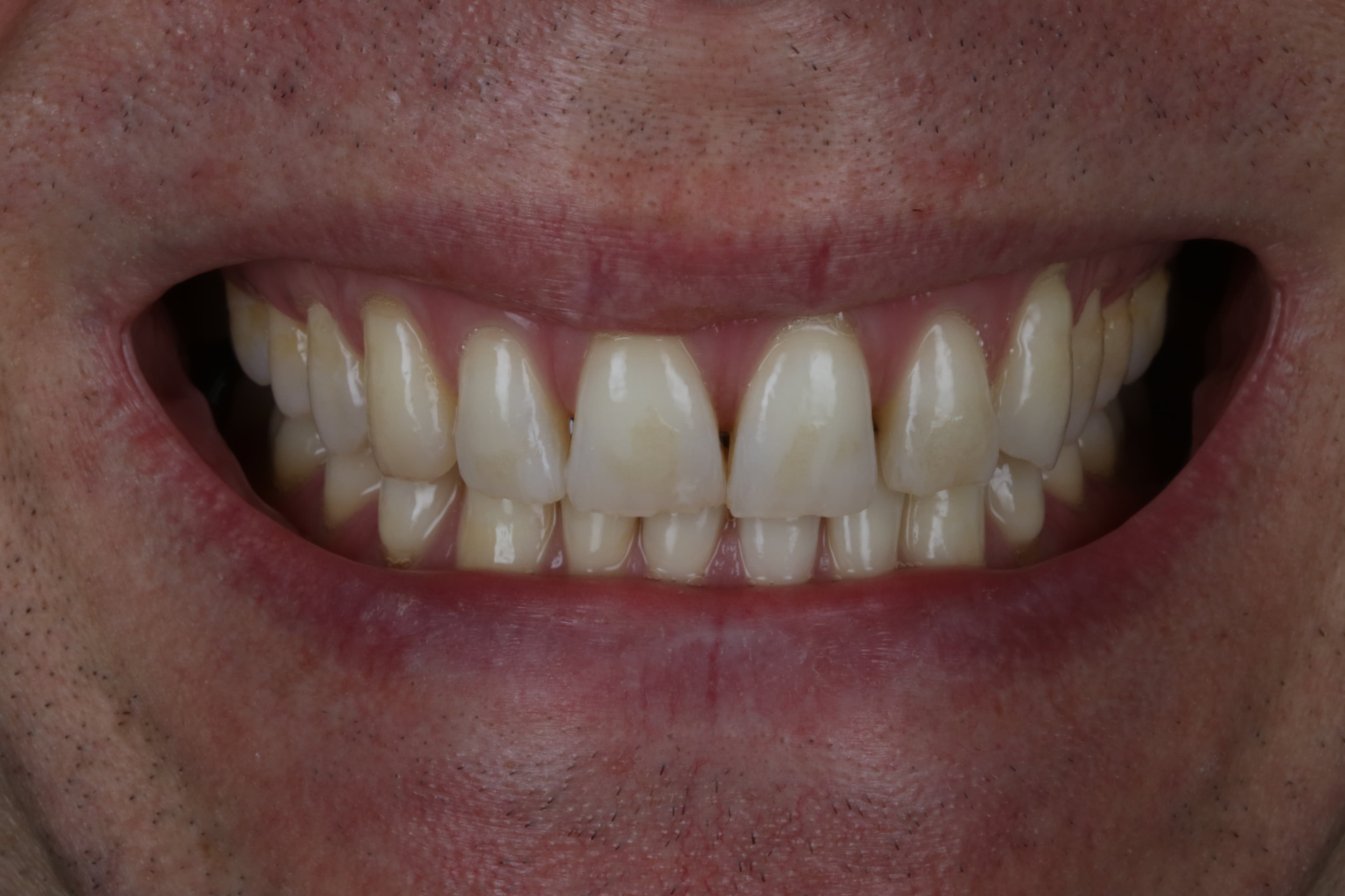 Before Composite Bonding — 4 Teeth