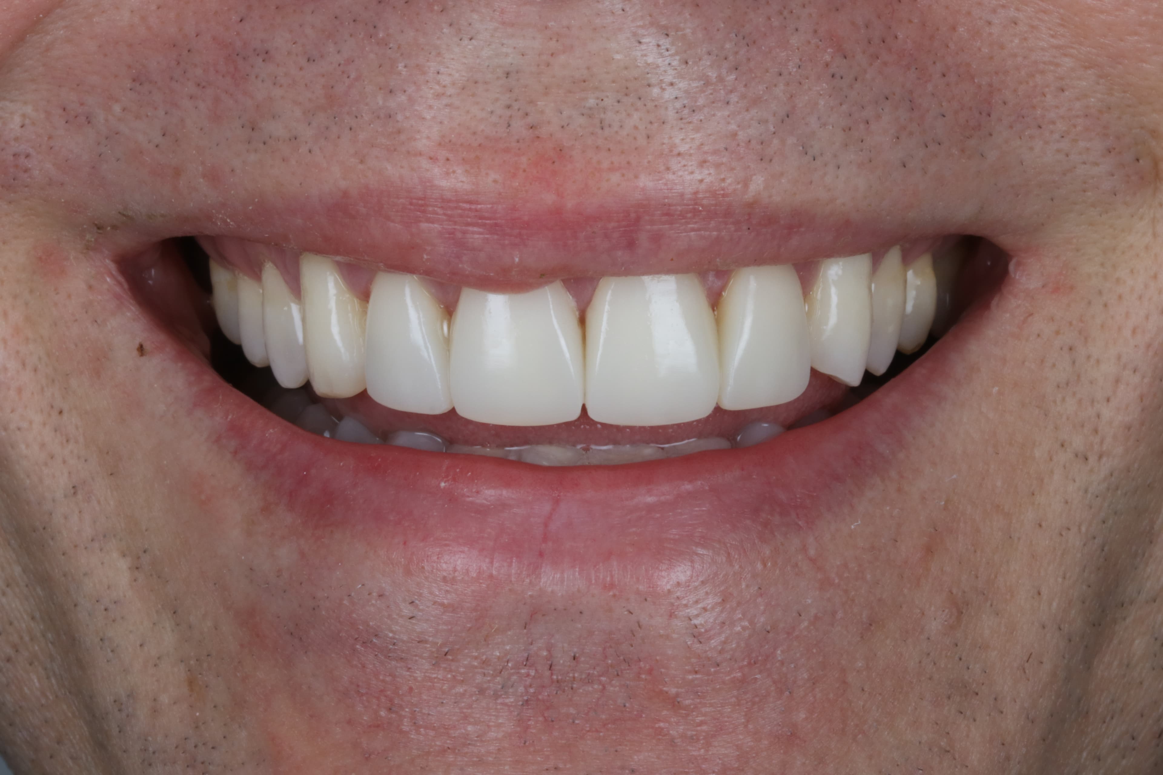 After Composite Bonding — 4 Teeth