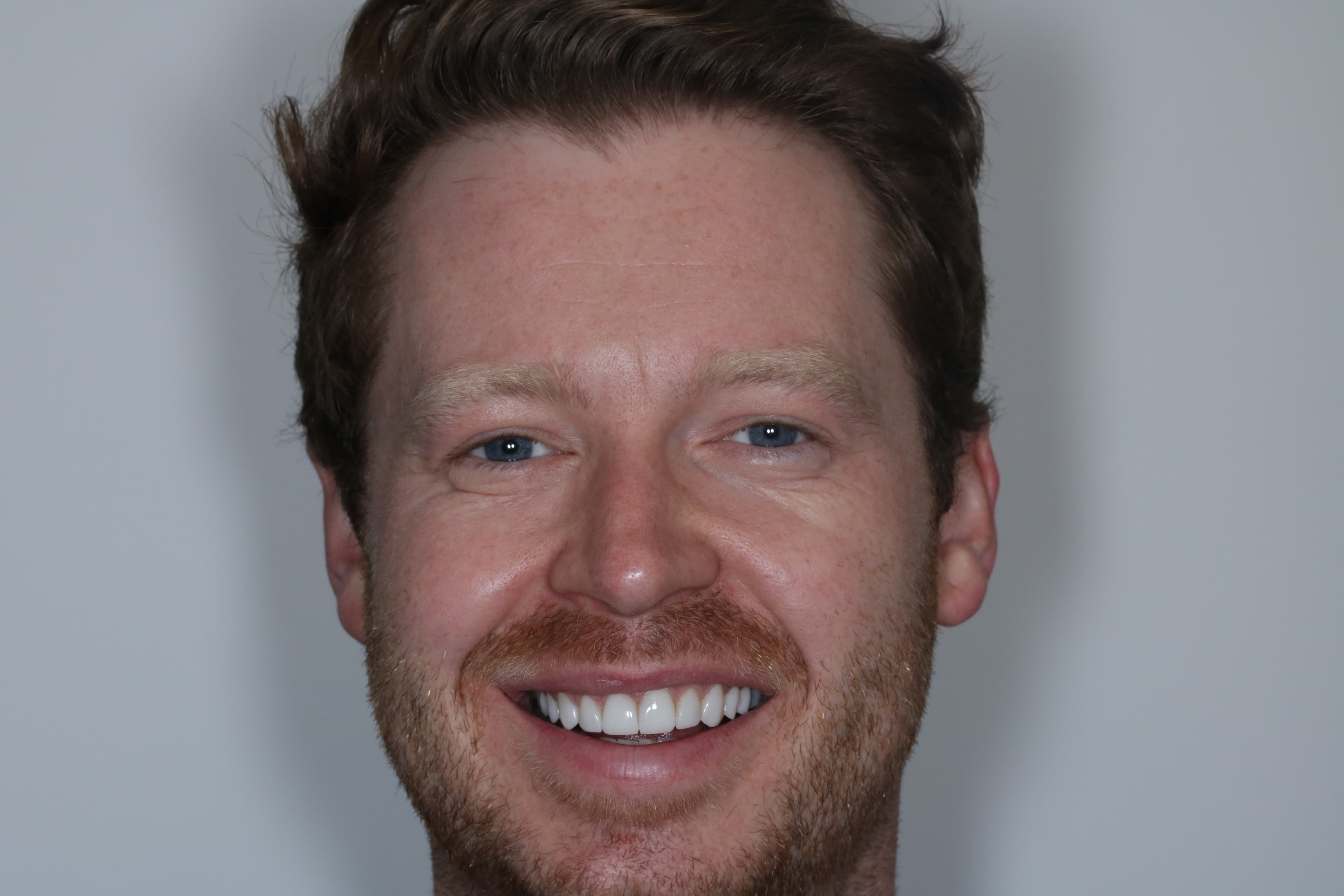 After Composite Bonding — 8 Teeth