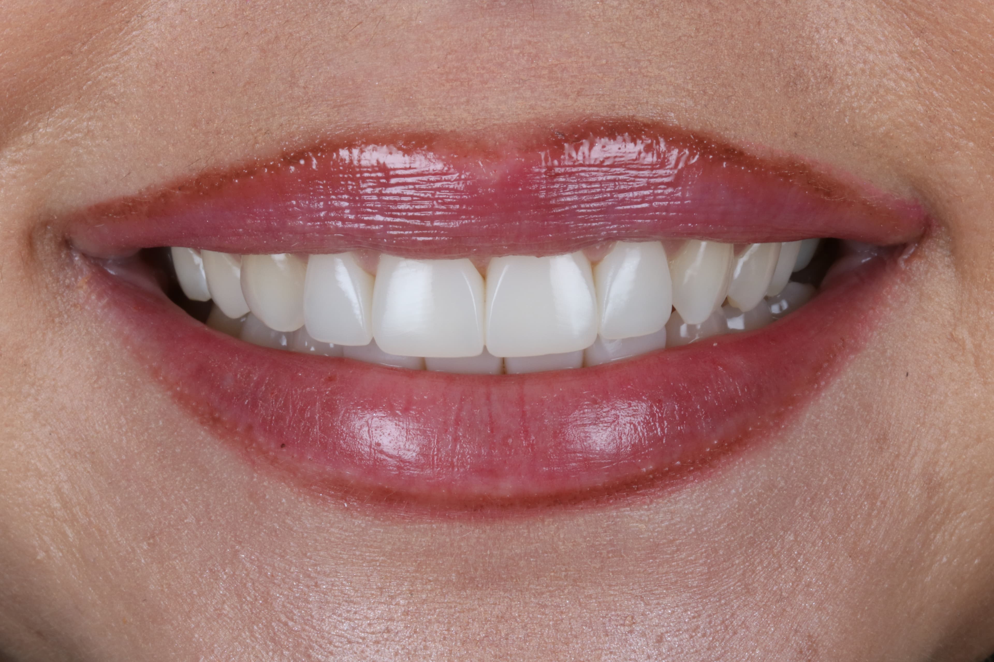 After Composite Bonding — 8 Teeth Upper & Lower