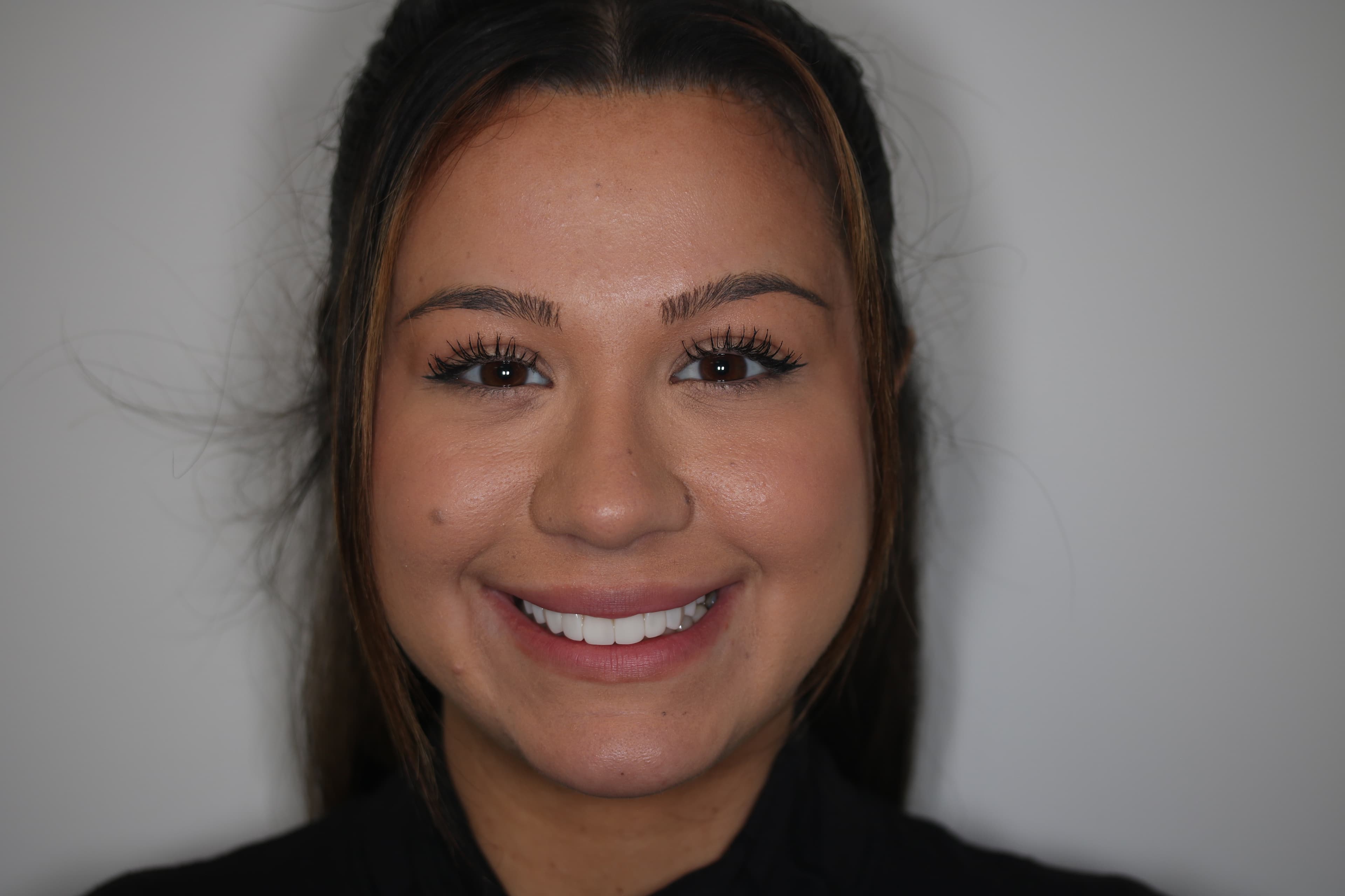 After Composite Bonding — 10 Teeth