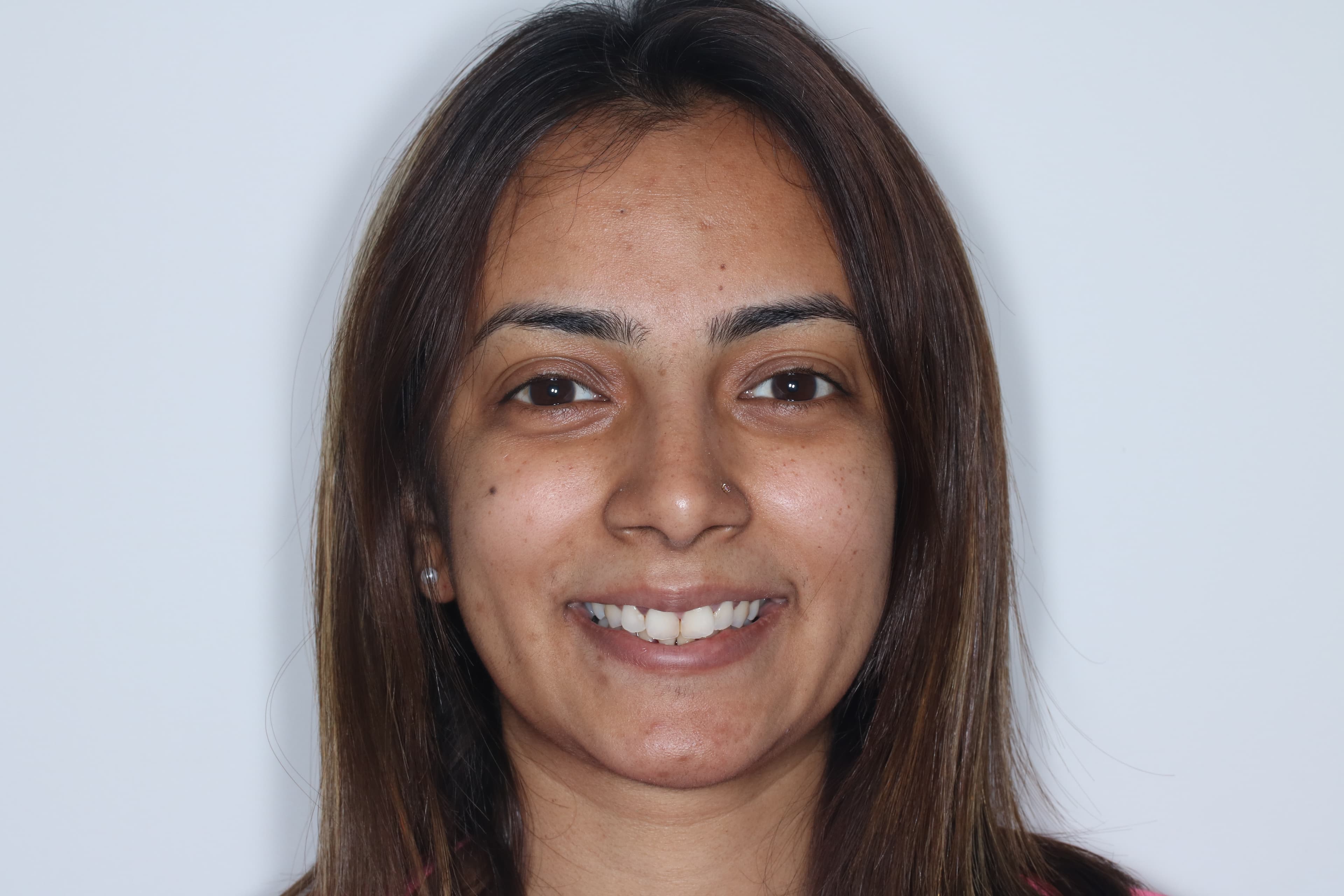 Before Composite Bonding — 8 Teeth