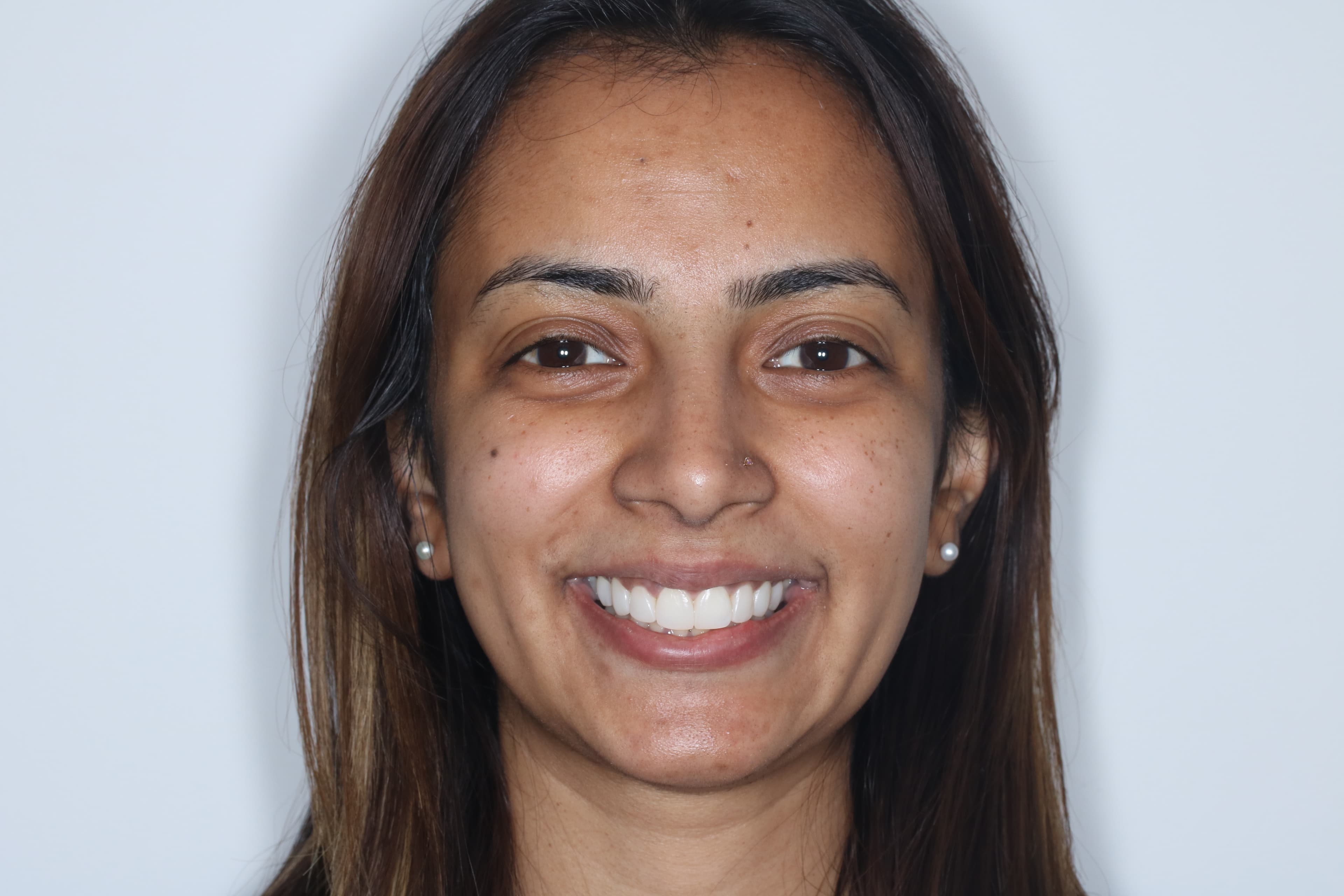 After Composite Bonding — 8 Teeth