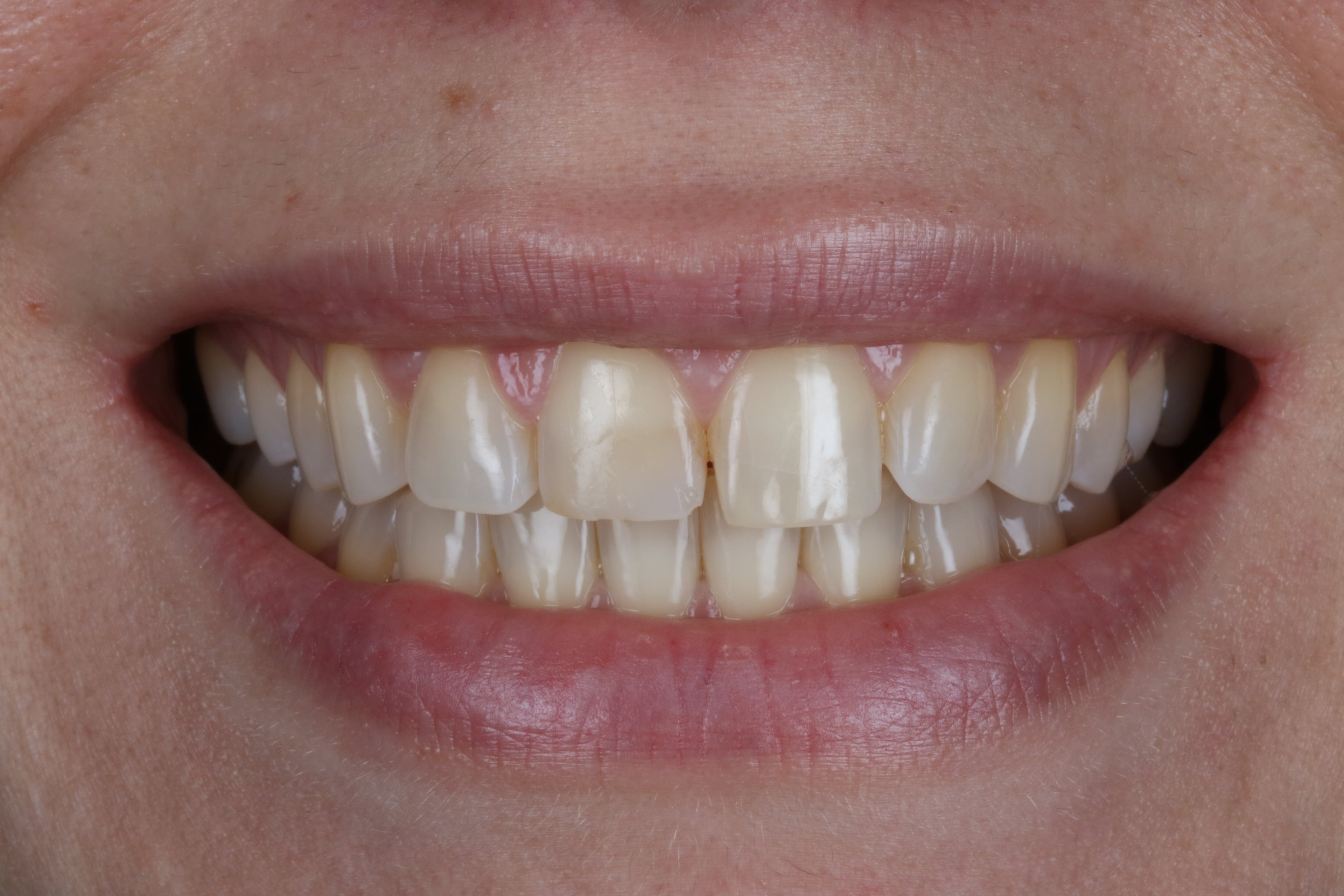 Before — Composite Bonding, 4 Teeth